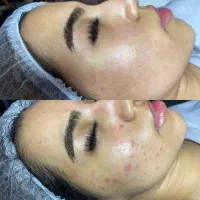 کربن تراپی بامتد مخصوص