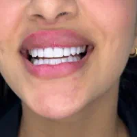 کامپوزیت دندان بابهترین موادفقط وفقط واحدی۹۹۹|خدمات آرایشگری و زیبایی|نیشابور, دارایی|دیوار