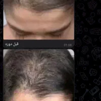 قطع ریزش در دوهفته|آرایشی، بهداشتی، درمانی|خوسف, |دیوار