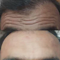 آف ژل وبوتاکس تضمینی(خانمهاوآقایان)