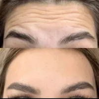 تخفیف تزریق ژل لب روسی لیفت صورت لیزرموهای زائدنخ|خدمات آرایشگری و زیبایی|تهران, صادقیه|دیوار