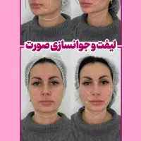 جشنواره پاییزه بوتاکس و فیلر و لیزر با تخفیف۳۰درصد|خدمات آرایشگری و زیبایی|اصفهان, فیض|دیوار