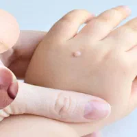 درمان قطعی زگیل|خدمات آرایشگری و زیبایی|رفسنجان, |دیوار
