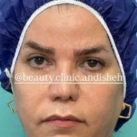 جراحی زیبایی بلفاروپلاستی،مینی لیفت صورت|خدمات آرایشگری و زیبایی|اندیشه, اندیشه فاز ۱|دیوار