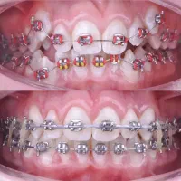 ارتودنسی هر فک فقط با ۵ تومن.کمترین هزینه شیراز