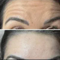 تزریق ژل و بوتاکس بصورت نقد و اقساط|خدمات آرایشگری و زیبایی|فولادشهر, ورزشگاه فولادشهر|دیوار