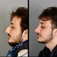 جراحی بینی در مجهز ترین کلینیک بدون تامپون|خدمات آرایشگری و زیبایی|تهران, شهر زیبا|دیوار