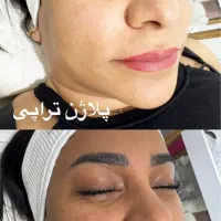 پلاژن تراپی /هایفو تراپی /لیزر بدن/کربوکسی|آرایشگاه و سالن‌های زیبایی|مشهد, کارگران|دیوار