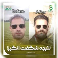 کاشت مو،ابرو، ریش و بلفارو پلاستی