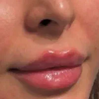 ترزیق ژل و بوتاکس،تخصصی و تضمینی|خدمات آرایشگری و زیبایی|نورآباد, |دیوار