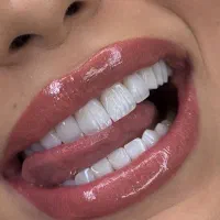 دندان پزشکی کامپوزیت لمینت بلچینگ روکش ایمپلنت