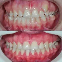 دندانپزشکی ایمپلنت دیجیتال ارتودنسی کامپوزیت لمینت|خدمات آرایشگری و زیبایی|شبستر, |دیوار