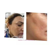 حذف کک‌و‌مک،خال در *یک جلسه*برای اولین باردر اهواز|خدمات آرایشگری و زیبایی|اهواز, کیانپارس |دیوار