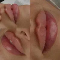 تزریق فیلر و بوتاکس و مزوتراپی لیزر