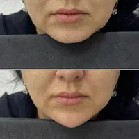 تزریقات ژل .بوتاکس .آنزیم .مزو ژل .مزوسر ضمانتی|خدمات آرایشگری و زیبایی|خرم‌آباد, |دیوار