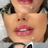 لیزرمو خالبردار هایفو12dبوتاکس ژل فیلر مزو پی آرپی