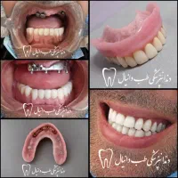 دندان مصنوعی،روکش،ایمپلنت دندانپزشکی دکتر نقوی
