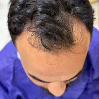 کاشت مو ب صورت حرفه ای وتضمینی