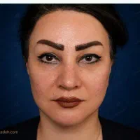 لیفت صورت و ابرو و شقیقه با مناسب ترین قیمت