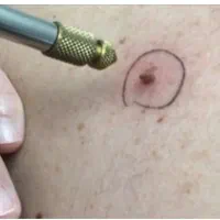 درمان پزشکی *زگیل تناسلی*اولین بار در اصفهان