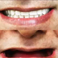 دندانسازی(دندان مصنوعی)تکی،چندتایی،کامل|آرایشی، بهداشتی، درمانی|کرمان, |دیوار