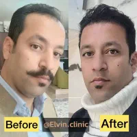 کاشت ابرو و مو برای خانم ها و آقایان با چک صیادی