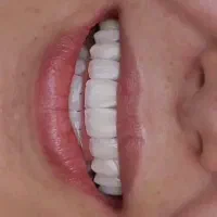 کامپوزیت دندان