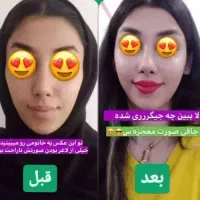 چاقی صورت تصمینی