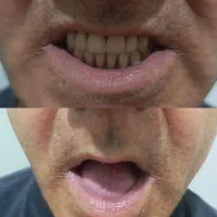 دندان مصنوعی