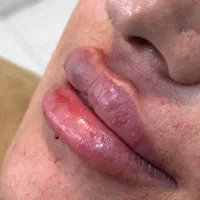 جشنواره ۳۰٪ تخفیفات ژل لب/فیلر صورت/بوتاکس/مزوژل|خدمات آرایشگری و زیبایی|مشهد, هنرستان|دیوار