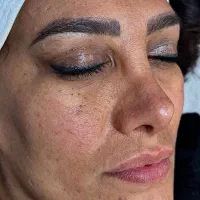 فیشال تخصصی زیر نظر پزشک