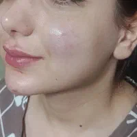 تزریق فیلر و چربی