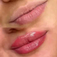 تخفیف تزریق ژل، بوتاکس در منزل|خدمات آرایشگری و زیبایی|گرگان, |دیوار