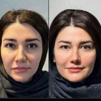 جشنواره طلایی  جوانسازی پوست با خون خودتون فقط ۳۹۹