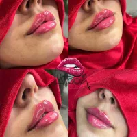 فیلرلب وصورت،بوتاکس،جوانساز،پرسینگ،آنزیم درکلینیک