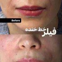 فیلر بوتاکس لیزر فیلربادی لاغری مزوتراپی prp جراحی|خدمات آرایشگری و زیبایی|مشهد, هنرستان|دیوار