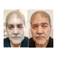 جراحی لیفت صورت پیشانی گونه شقیقه غبغب پلک|خدمات آرایشگری و زیبایی|تهران, ظفر|دیوار