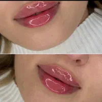 تزریق ژل و بوتاکس مزو جوانساز توسط پزشک تخفیف 30/