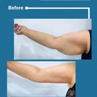 جشنواره بلفاروپلاستی با بخیه لیزری،لیفت شقیقه و..|خدمات آرایشگری و زیبایی|مشهد, کوه سنگی|دیوار