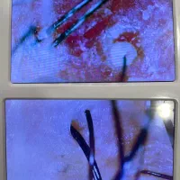 رویش مجدد مو با آرایش دائم سر به روش FUT و FUE