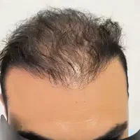 پرپشتی مو در سه روز بدون کاشتمو|خدمات آرایشگری و زیبایی|جهرم, |دیوار