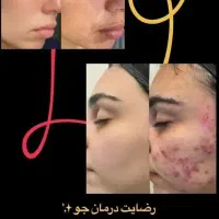 سرم مغذی و ویتامین آ، کرم ضد لک لاکچری کوین