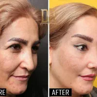 لیفت فول فیس صورت لیفت چشم گربه ای بدون عمل جراحی|خدمات آرایشگری و زیبایی|ری, دیلمان|دیوار