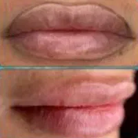 ریموو و پاک کردن تخصصی تاتو توسط مستر ریموو|خدمات آرایشگری و زیبایی|تهران, دهکده المپیک|دیوار