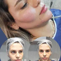 جشنواره پی آرپی ژل و بوتاکس مزوتراپی بلفارو|خدمات آرایشگری و زیبایی|اهواز, کیانپارس |دیوار