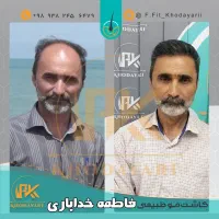 کاشت مو اقساطی و تضمینی بدون پیش پرداخت در اهواز