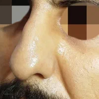 اصلاح فرم بینی بدون جراحی|خدمات آرایشگری و زیبایی|رشت, بلوار گیلان|دیوار
