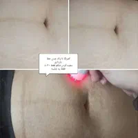 فیشیال و پاکسازی تخصصی ودرمان مشکلات پوستی(تخفیف)|خدمات آرایشگری و زیبایی|گرگان, |دیوار