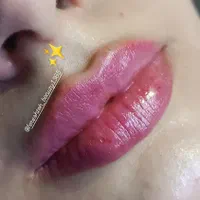 خدمات تزریق فیلر صورت بوتاکس مزوتراپی ولیزر|خدمات آرایشگری و زیبایی|نسیم‌شهر, |دیوار