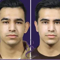 اتوپلاستی و اصلاح فرم گوش